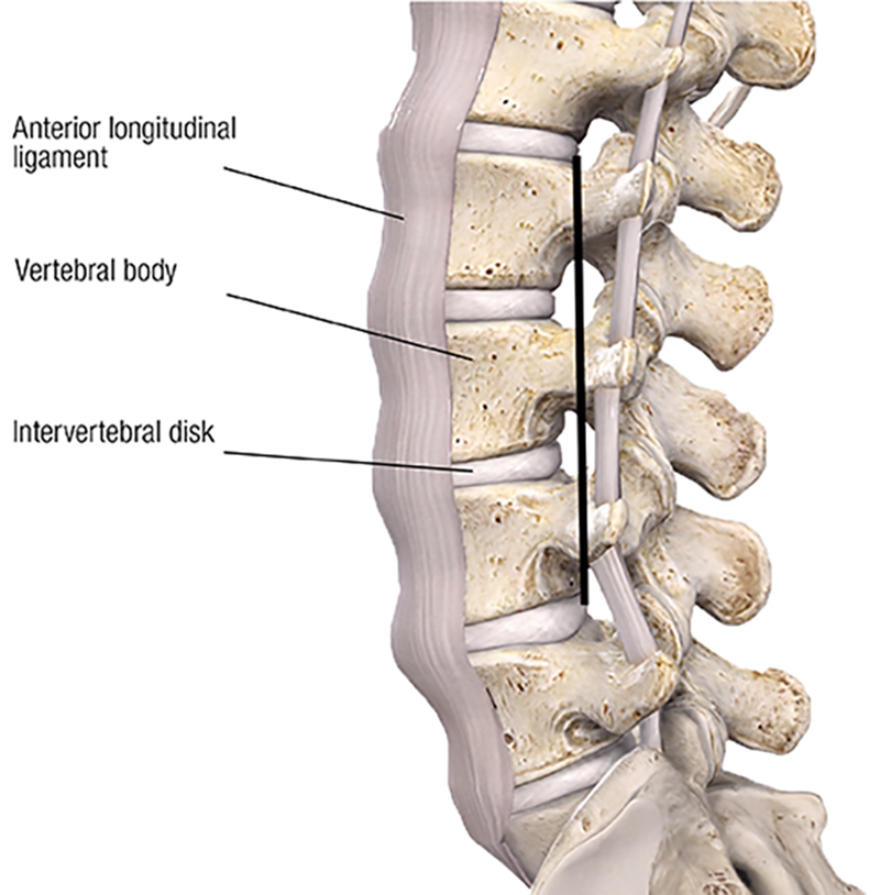 JF20_Lumbar Spine1 The intervertebral disk and vertebral bodies manage the large compressive loads of the spine. The majority of upper body weight is transmitted to the skeleton of the lower body through the lumbar spine. That is why the intervertebral disks and vertebral bodies are largest in the lumbar region. The lumbar motion segments must carry that compressive load while still being mobile. The third component, the anterior longitudinal ligament, limits spinal extension and helps maintain the structural integrity of the intervertebral disk.