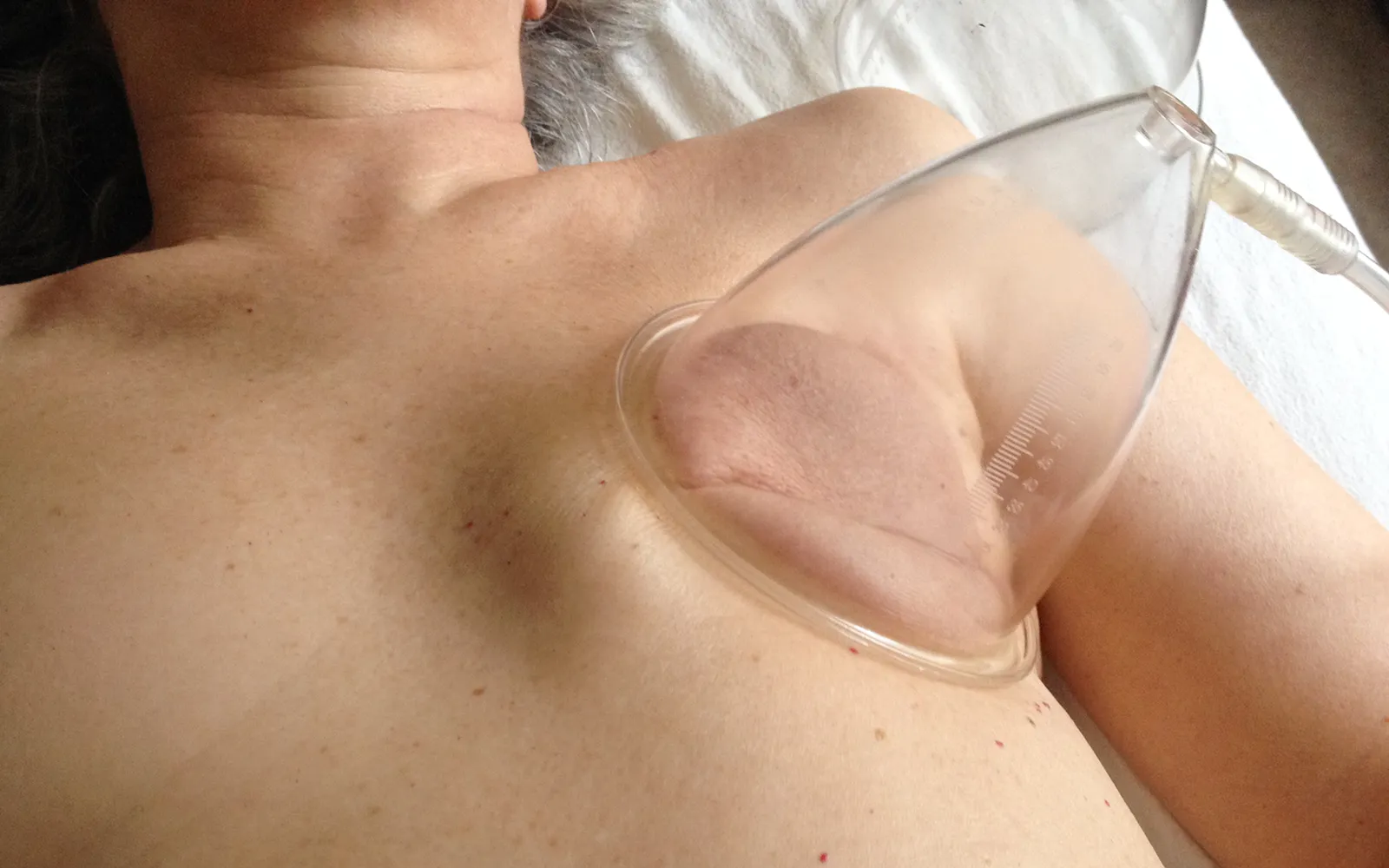JA_16_VacuumManual_Secondary5_masectomy_1600