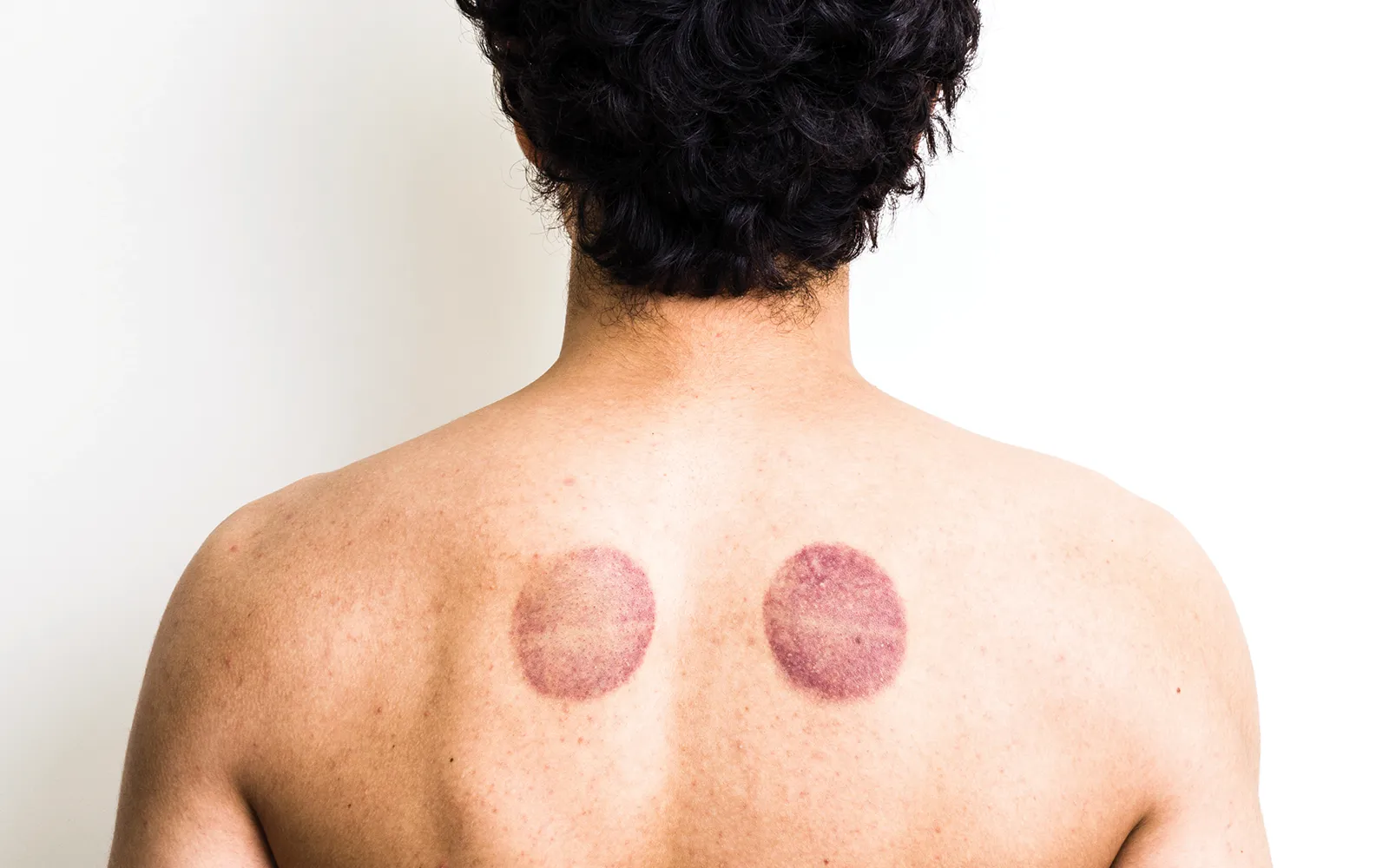 JA_16_CuppingTherapy_Secondary3_1600