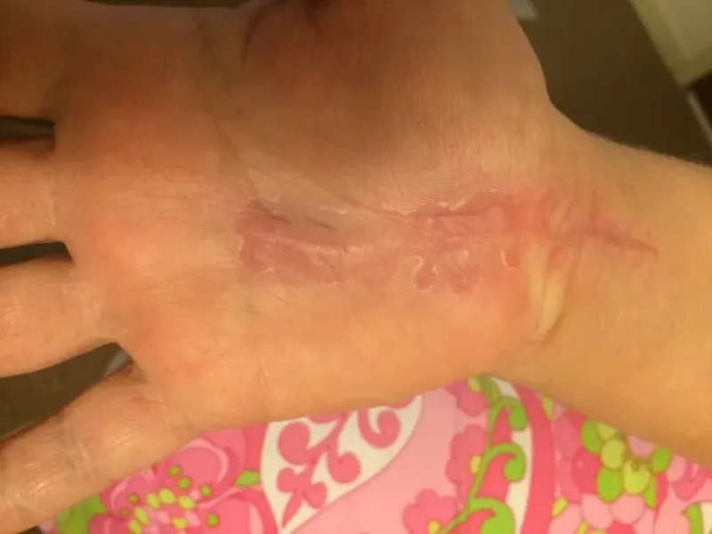 JA20_scars carpal2 JA20_scars carpal2