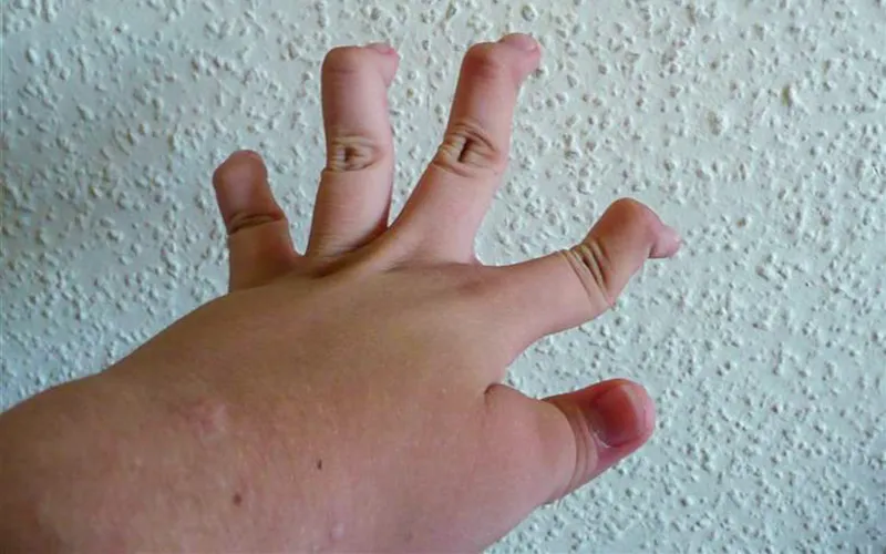 ND19_Ehlers-Danlos Syndrome1