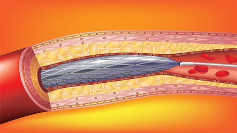 Animated image of a stent on the descending branch of the coronary artery.