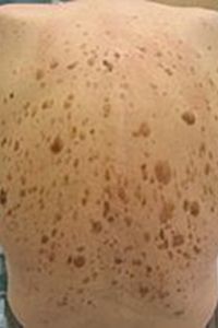 Seborrheic Keratosis