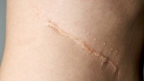 An image of a post-surgical scar located on the back.